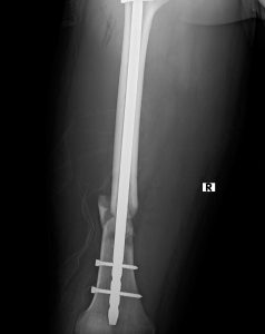 broken human thigh with steel screw inside x-ray